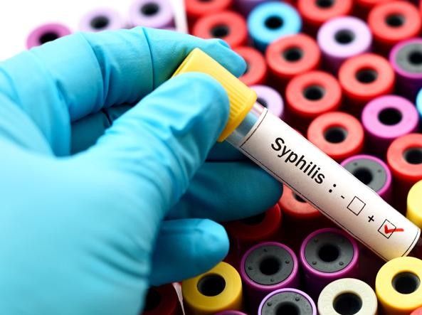 Sifilide, la Regina delle Malattie Sessualmente Trasmissibili